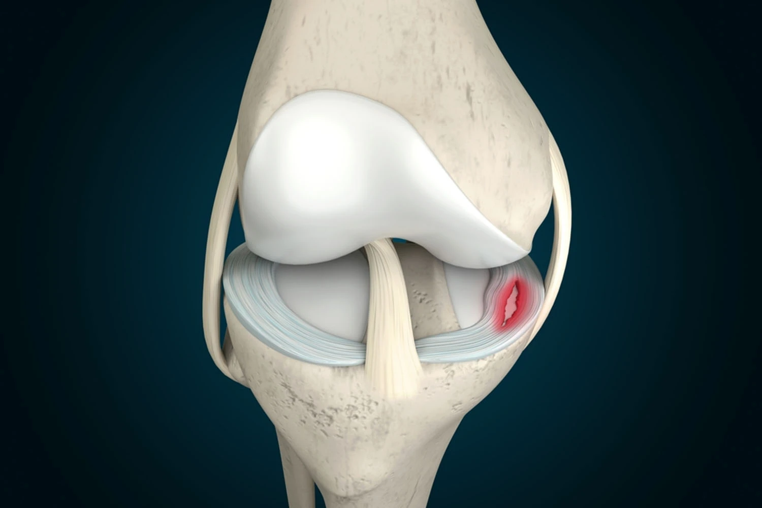 Illustration showing a tear within the knee meniscus