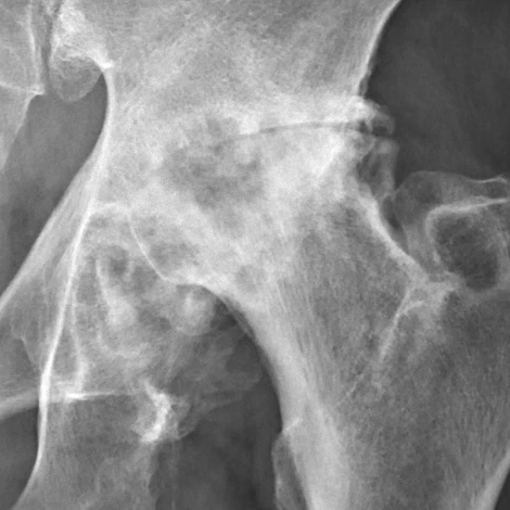 X-ray showing severe hip osteoarthritis
