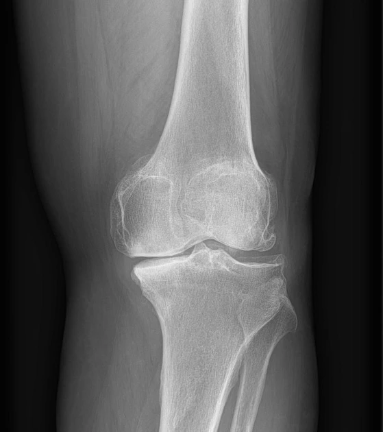 Weight-bearing X-ray showing advanced knee osteoarthritis